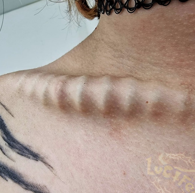 Body implant