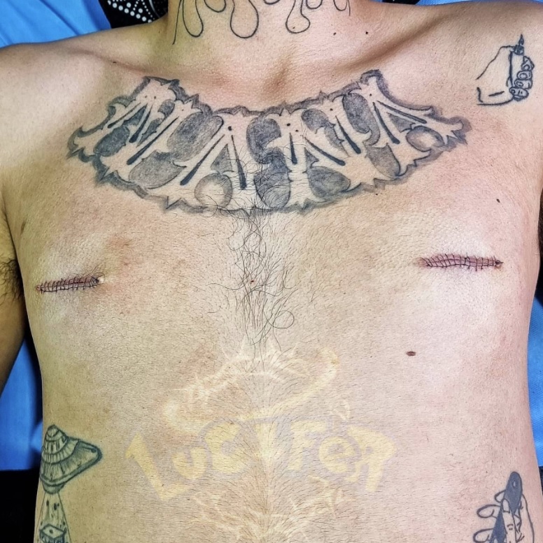 Ablation des tétons ≠ nipple removal