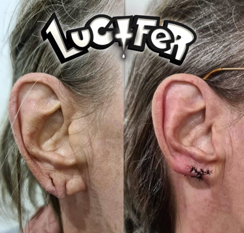 Une reconstruction d'une oreille qui en avais grande besoin